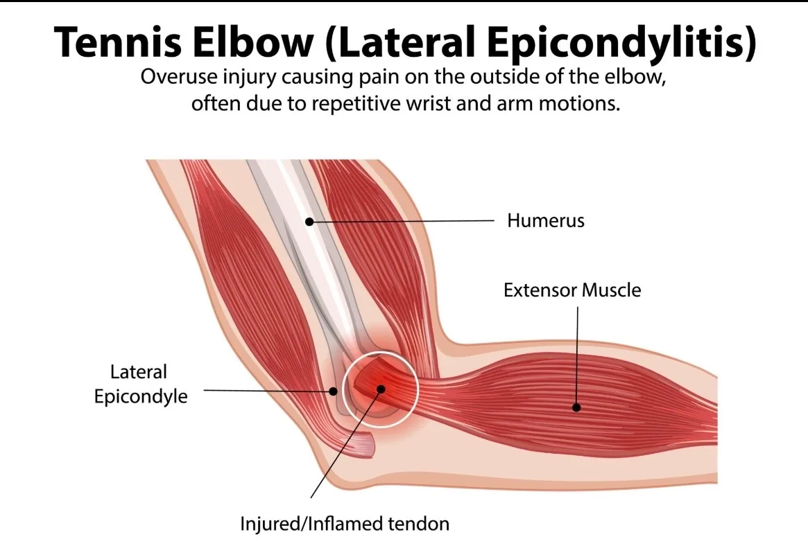 Tennis player demonstrating proper racket swing mechanics to prevent elbow stress and lateral epicondylitis